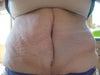 3 weeks post op