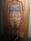Before tummy tuck