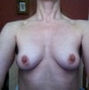 Before Surgery