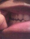 Open Posterior Bite