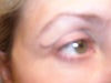 Right eyelid scar extends up toward eyebrow. Eyeshadow does not cover it.