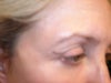 Right eyelid scar