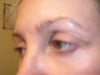 left eyelid scar