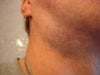 I now have a bulge, which aches, where pre-surgery I had a better jawline.