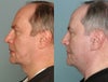 Image on left is pre-op. right is post-op with submental collapse. Despite puffiness, body weight was less post op.