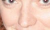 Bump on one side of nose.