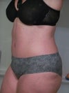 If you look at the profile going down my body you can see the "hump" as I refer to it.