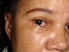 Large hump in the middle of my eye after cheek implant .