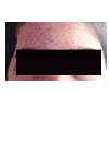Right zygoma has less prominence.Both halves of my face do not appear symmetrical.