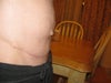 12 Weeks Post-Op Side View