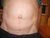 12 Weeks Post-Op Front View