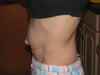 Pre-op Side View