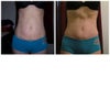 pre op and 12 wks