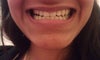 My front teeth just biting