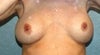 BEFORE 10 yr saline, flipped in mirror
