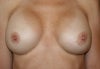 3 mos post op