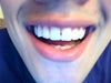 The black triangle in my front two incisors. I have two others in between the other incisors. The gap is slightly bigger than what it seems to be in the image.