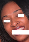Nostrils in smile