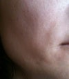 here you can see the holow after hyaluronidase