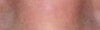 after corrective surgery (squinting eyes)
