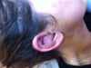 Cauliflower ear very painful I hope it goes back to normal?