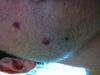 Here are the two treatment zones.  I also have a regular mole on the bottom.
