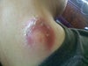 Lipoma 1