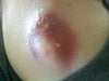 Lipoma 2