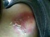 Lipoma 3