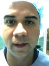 Right before second surgery to repair the overcorrection