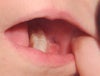 Granular tissue inside mouth.