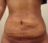 2 weeks after surgery, showing bulge on top of my stitches.