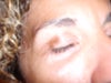 hyperpigmentation