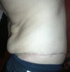3 months post op