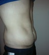 3 months post op