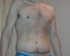 3 months post op