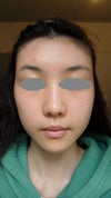 Before, frontal view