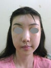After, frontal view