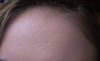 2 or 3 depressed forehead scars that I dont think are even from my acne as my acne is very moderate and not cystic