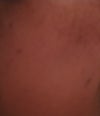 face, left side 
I'm wondering what would be the most effective way of treatment, chemical peeling, laser, IPL?!