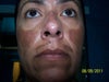 10 days after 2nd Vipeel