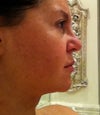 week 1 post op right side
