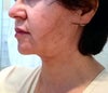 week 2 post op left side (worst side for swelling and tenderness)