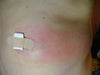 Lump as viewed from front