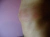 Lump as viewed from the side of the lump