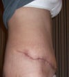 rt side incision