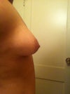 side view of right breast