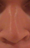 This is the nose after primary (current)