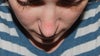 My nose, 3 months and 5 days after rhinoplasty