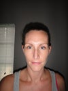 Still swollen, but note that tip is VERY asymmetric. It was hard to photograph asymmetry at to of nose bridge near eyes. (7 wks post-op)